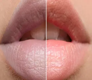 Xử Lý Môi , Thâm , Đen , Chì Hỏng