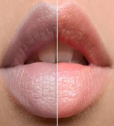 Xử Lý Môi , Thâm , Đen , Chì Hỏng